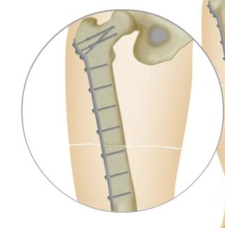 Cómo se hace un trasplante de piernas | Recurso educativo 44511